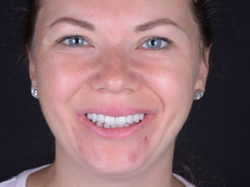 Lucrare estetică #2 — DENTCRAFT Satu Mare