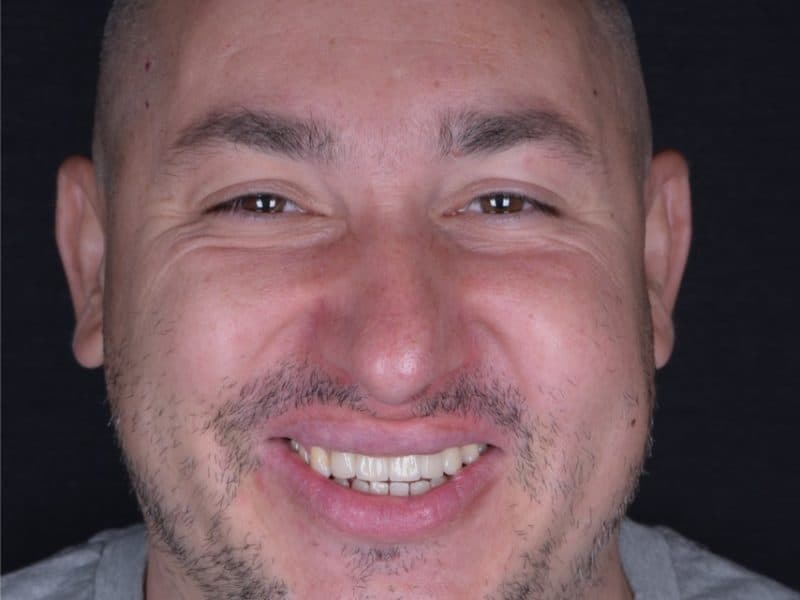 Lucrare estetică #4 — DENTCRAFT Satu Mare